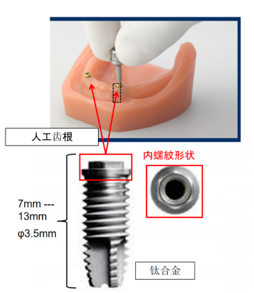 种植牙内螺纹铣削.png